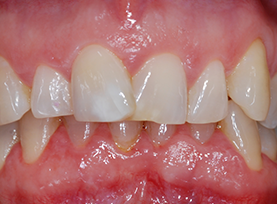 Before Treatment